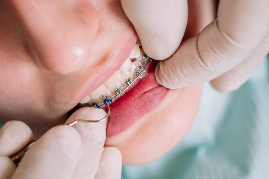 Dentista ajustando brackets metálicos en tratamiento de ortodoncia