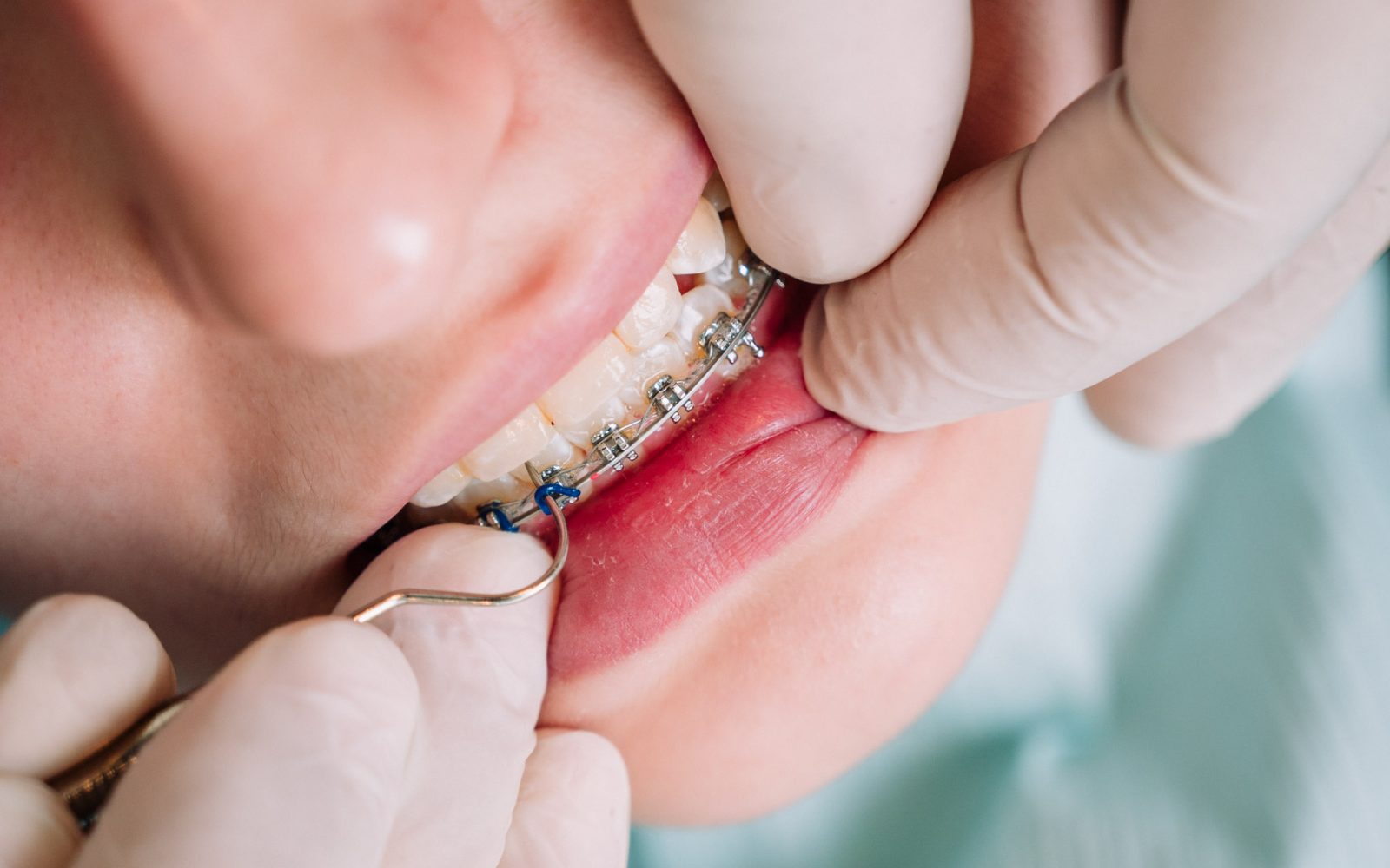 Dentista ajustando brackets metálicos en tratamiento de ortodoncia