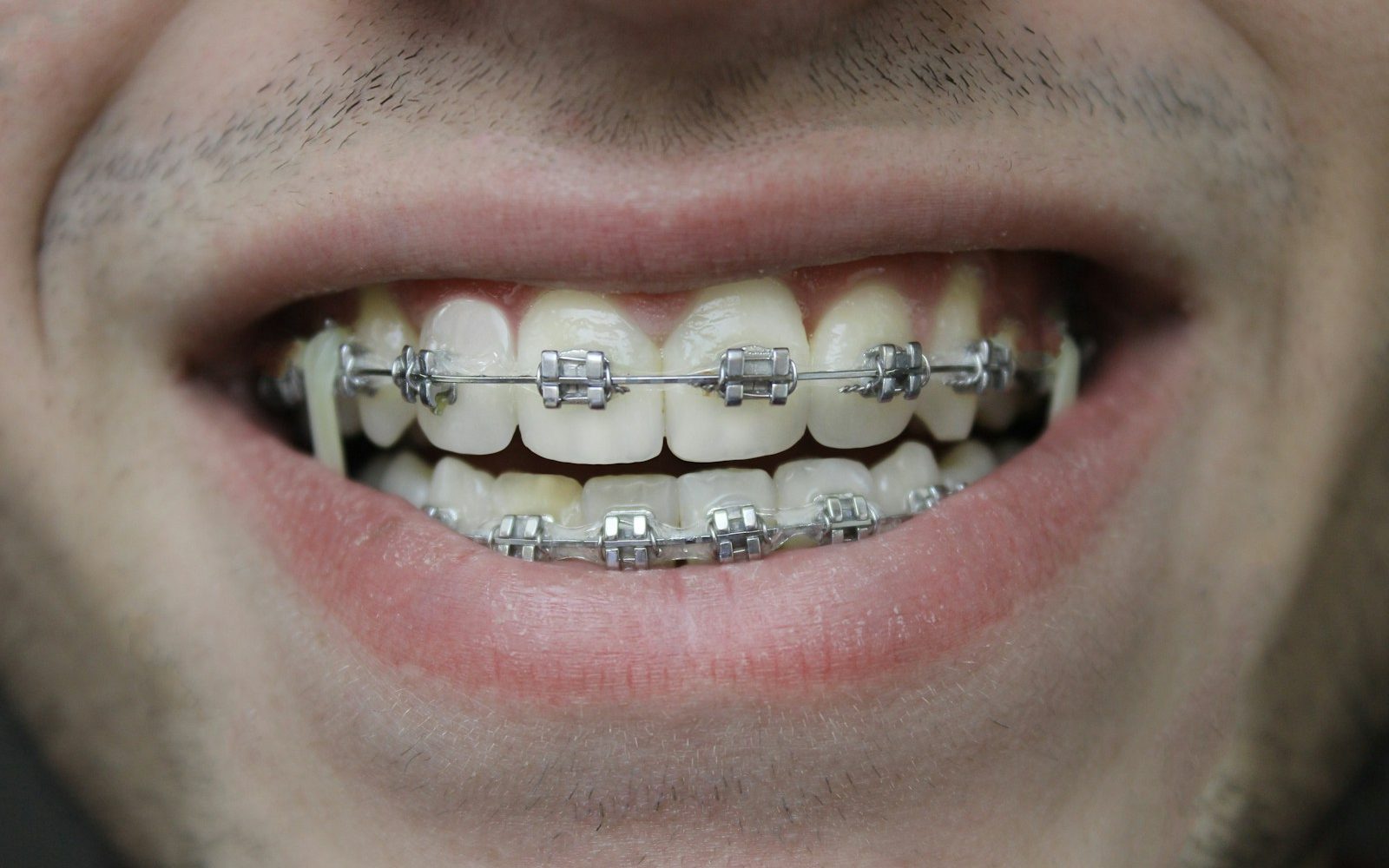 Paciente adulto con brackets metálicos en tratamiento de ortodoncia dental